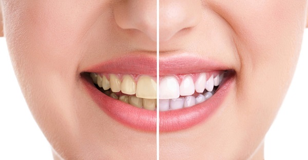 Những nguyên nhân khiến răng bị ố vàng Những nguyên nhân khiến răng bị ố vàng