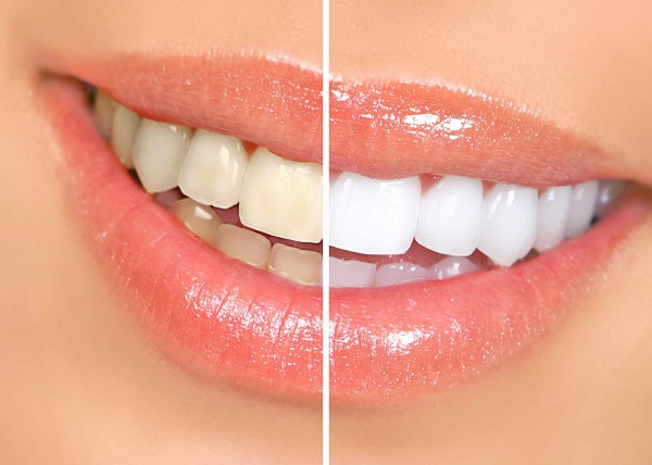 Những phương pháp tẩy trắng răng tại nhà có hiệu quả