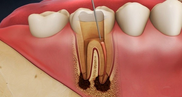 Những tác nhân gây ra viêm tủy răng