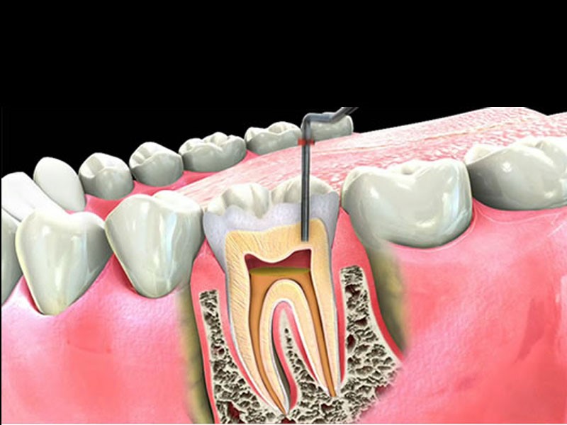 Những tác nhân gây ra viêm tủy răng