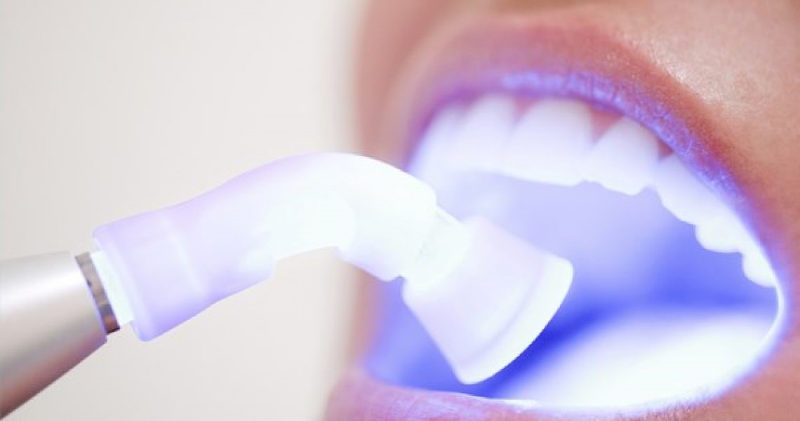 Những thắc mắc thường gặp trước khi tẩy trắng răng