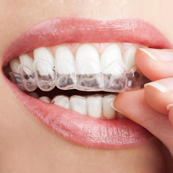 Những thông tin cần biết về máng tẩy trắng răng