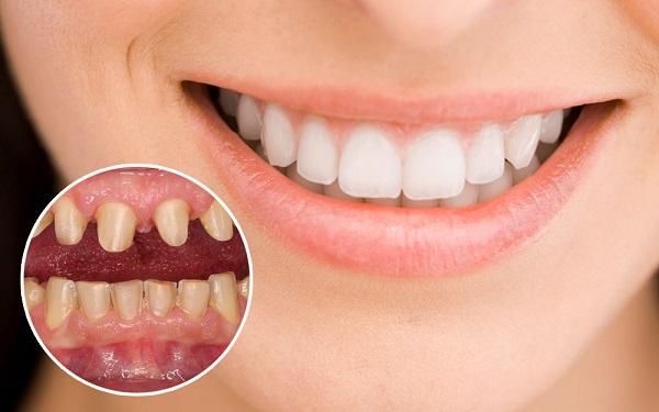 Những trường hợp không nên bọc răng sứ trung tâm nha khoa chữa bệnh răng  miệng uy tín