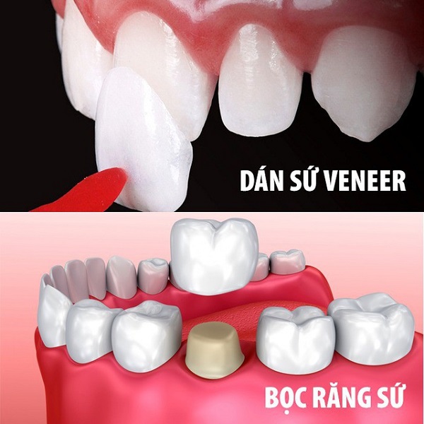 Những trường hợp không nên bọc răng sứ Những trường hợp không nên bọc răng sứ
