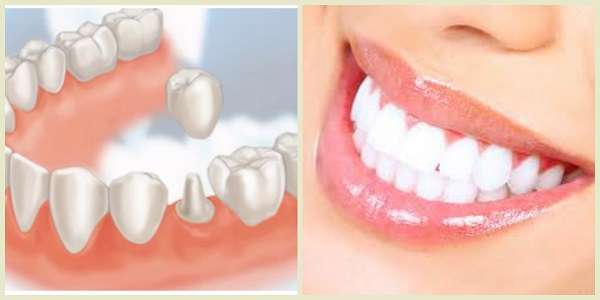 Những trường hợp không nên bọc răng sứ Những trường hợp không nên bọc răng sứ
