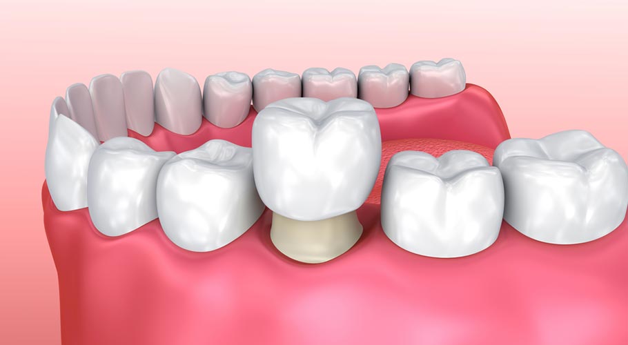 Những ưu điểm không ngờ từ phương pháp bọc răng sứ Những ưu điểm không ngờ từ phương pháp bọc răng sứ