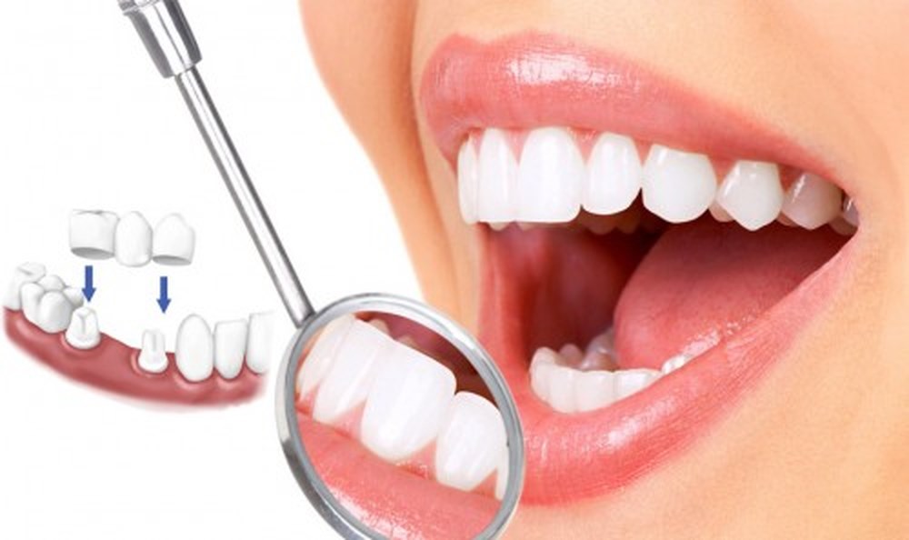 Những ưu điểm không ngờ từ phương pháp bọc răng sứ Những ưu điểm không ngờ từ phương pháp bọc răng sứ
