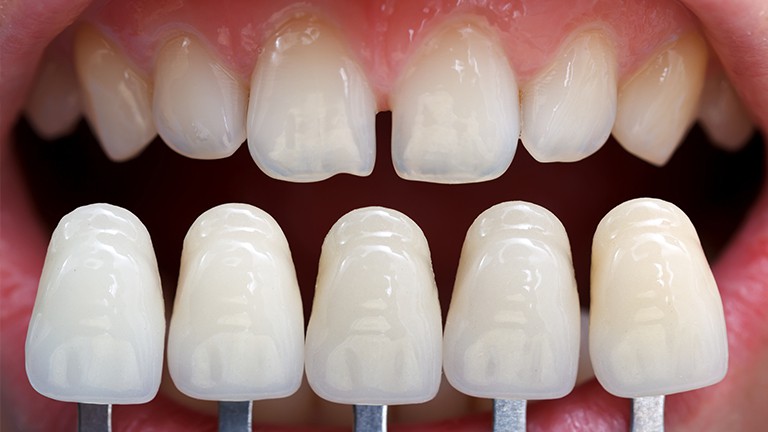 Những ưu điểm không ngờ từ phương pháp bọc răng sứ Những ưu điểm không ngờ từ phương pháp bọc răng sứ