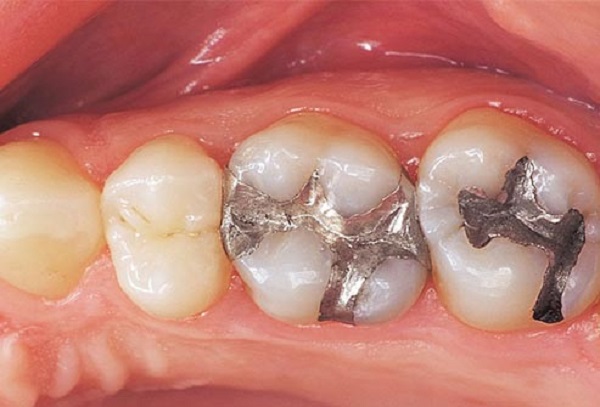 Những vấn đề nha khoa phổ biến hiện nay Những vấn đề nha khoa phổ biến hiện nay