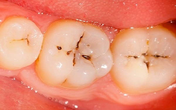 Những vấn đề nha khoa phổ biến hiện nay Những vấn đề nha khoa phổ biến hiện nay