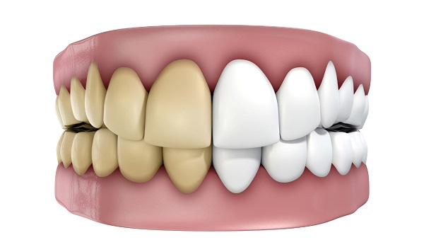 Những vấn đề nha khoa phổ biến hiện nay Những vấn đề nha khoa phổ biến hiện nay