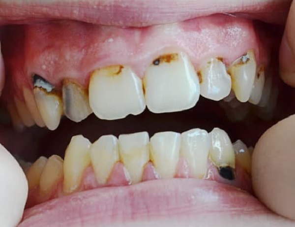 Những vấn đề nha khoa phổ biến hiện nay Những vấn đề nha khoa phổ biến hiện nay