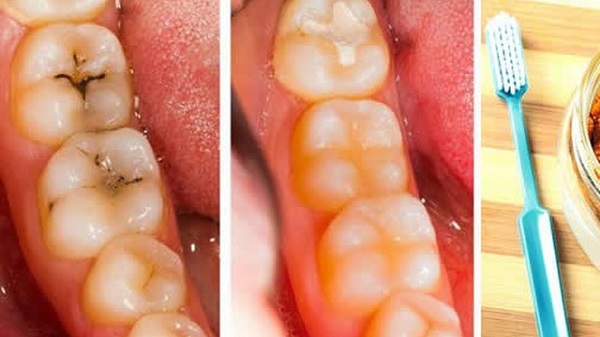 Những vấn đề nha khoa phổ biến hiện nay Những vấn đề nha khoa phổ biến hiện nay