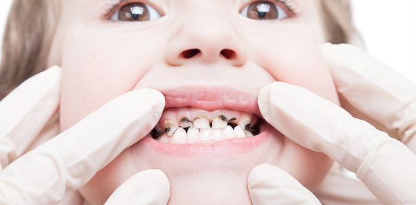 Những yếu tố thường làm hư răng ở trẻ