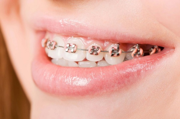 Niềng răng có làm thẳng răng ở trẻ em và người lớn không Niềng răng có làm thẳng răng ở trẻ em và người lớn không