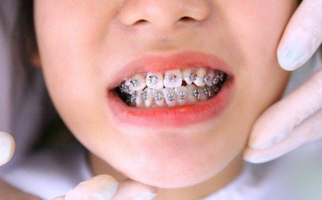 Niềng răng có làm thẳng răng ở trẻ em và người lớn không Niềng răng có làm thẳng răng ở trẻ em và người lớn không