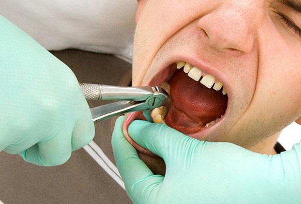 Niềng răng có làm thẳng răng ở trẻ em và người lớn không Niềng răng có làm thẳng răng ở trẻ em và người lớn không