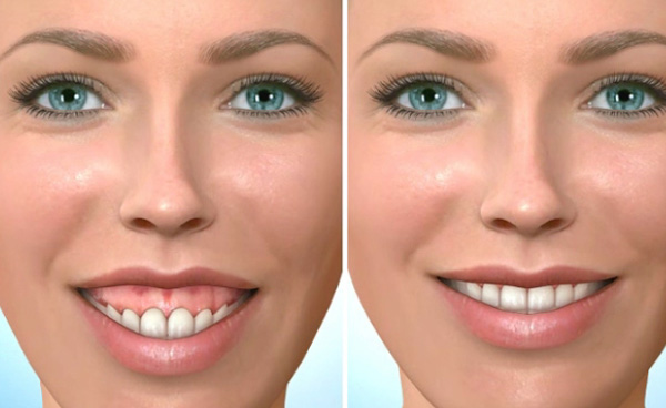 niềng răng insalign niềng răng insalign