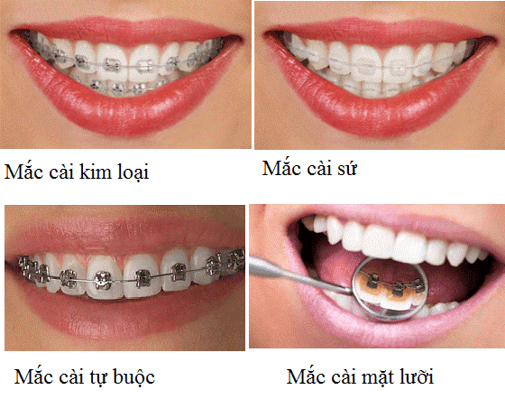 Niềng răng tại nha khoa tân phú