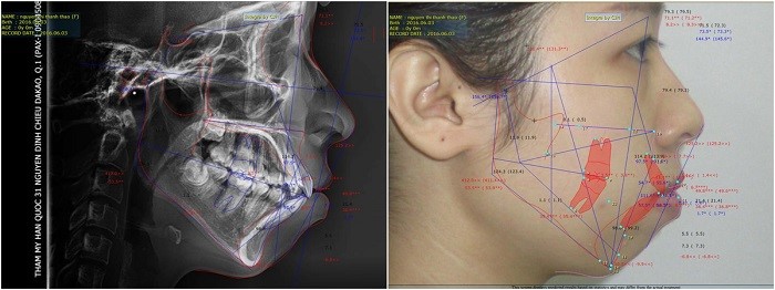 Niềng răng tại nha khoa tân phú