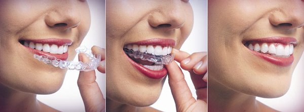 Niềng răng trong suốt có tốt hơn niềng răng kim loại Niềng răng trong suốt có tốt hơn niềng răng kim loại