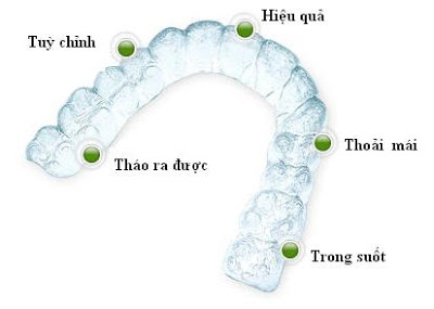 Niềng răng trong suốt có tốt hơn niềng răng kim loại