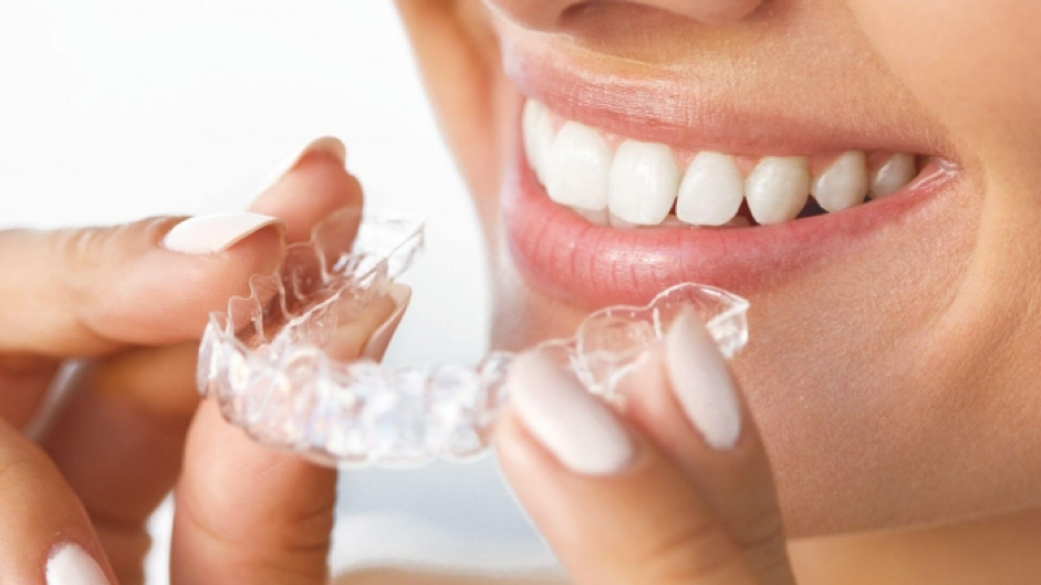 Niềng răng trong suốt có tốt hơn niềng răng kim loại Niềng răng trong suốt có tốt hơn niềng răng kim loại