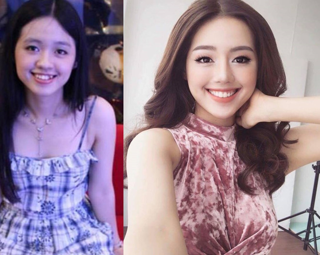 niềng răng trước va sau niềng răng trước va sau