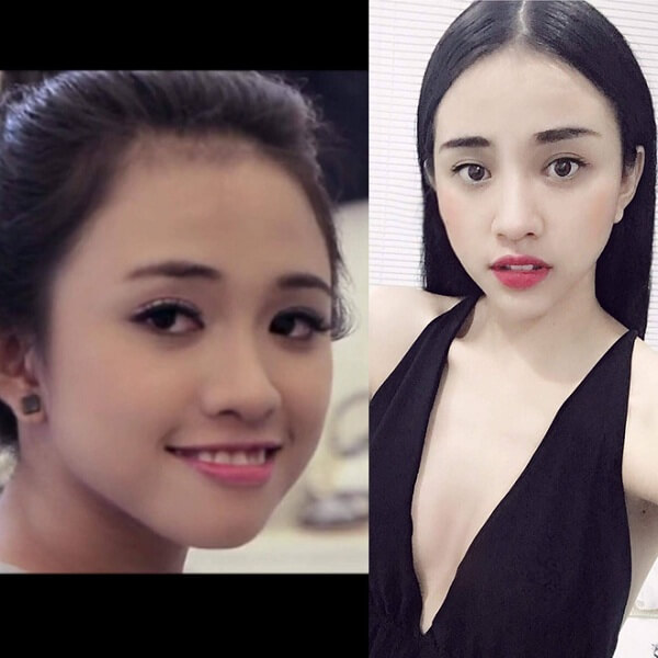 niềng răng trước và sau niềng răng trước và sau