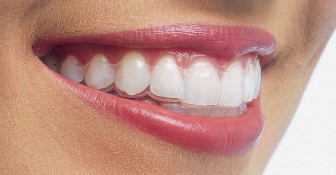 dịch vụ niềng răng insalign dịch vụ niềng răng insalign