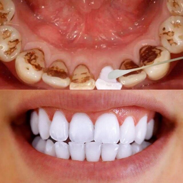 Phải làm thế nào để răng không còn ố vàng