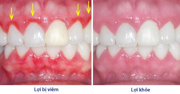 Quá trình thay răng ở trẻ em