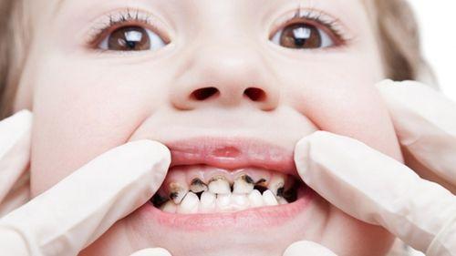 răng bị đen bên trong răng bị đen bên trong