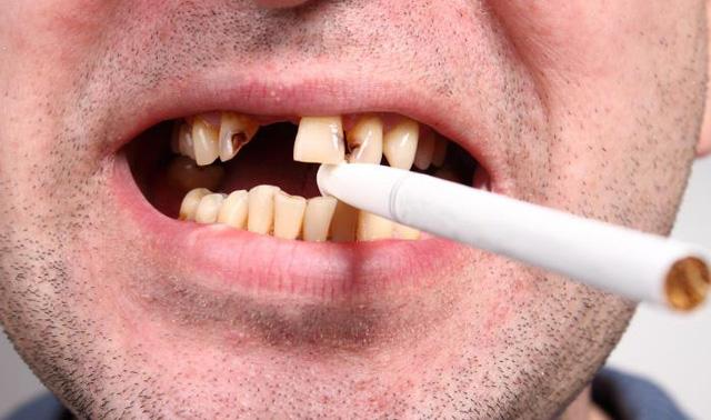 răng bị đen bên trong răng bị đen bên trong