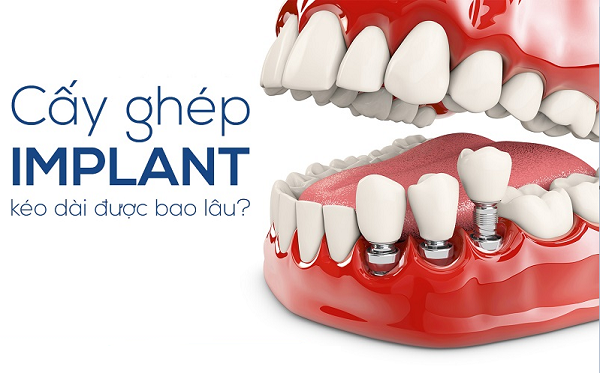 Răng implant sử dụng được bao lâu thì phải làm lại Răng implant sử dụng được bao lâu thì phải làm lại