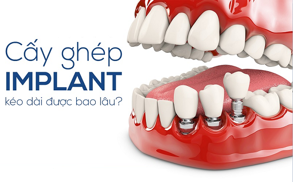 Răng implant sử dụng được bao lâu thì phải làm lại