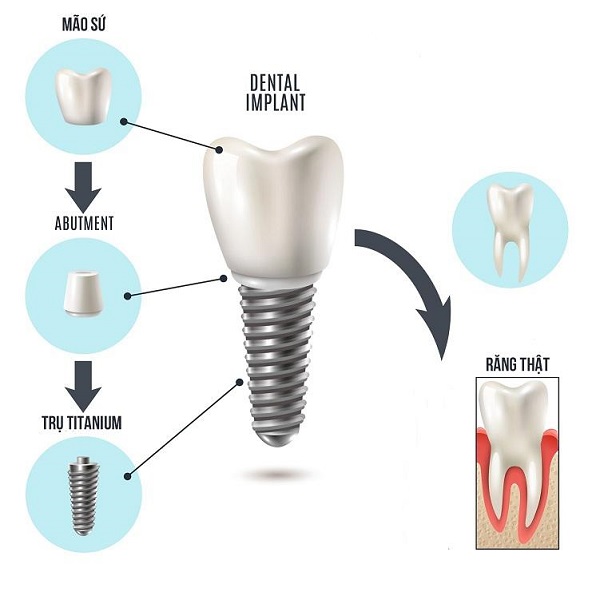 Răng implant sử dụng được bao lâu thì phải làm lại Răng implant sử dụng được bao lâu thì phải làm lại