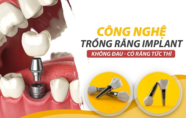 Răng implant sử dụng được bao lâu thì phải làm lại