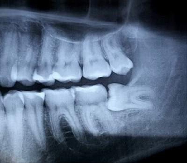 Răng khôn có tác dụng gì và khi nào nên nhổ răng khôn Răng khôn có tác dụng gì và khi nào nên nhổ răng khôn