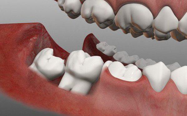 Răng khôn có tác dụng gì và khi nào nên nhổ răng khôn