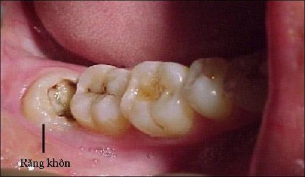 Răng khôn có tác dụng gì và khi nào nên nhổ răng khôn Răng khôn có tác dụng gì và khi nào nên nhổ răng khôn