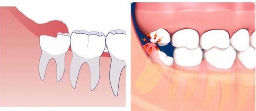 răng khôn mọc ngầm và những tác hại to lớn mà bạn không biết 