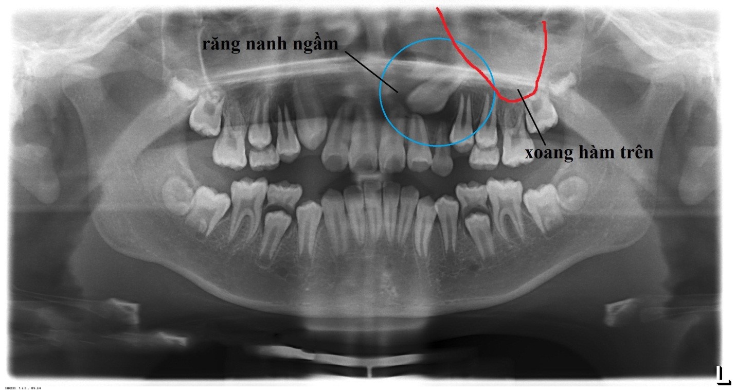răng khôn mọc ngầm và những tác hại to lớn mà bạn không biết răng khôn mọc ngầm và những tác hại to lớn mà bạn không biết