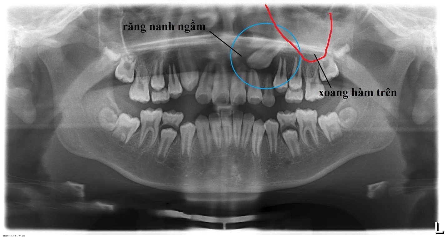 răng khôn mọc ngầm và những tác hại to lớn mà bạn không biết 