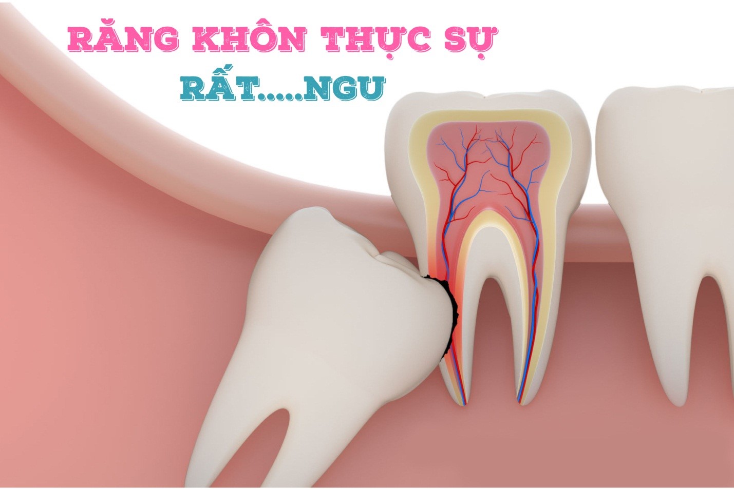 răng khôn mọc ngầm và những tác hại to lớn mà bạn không biết 