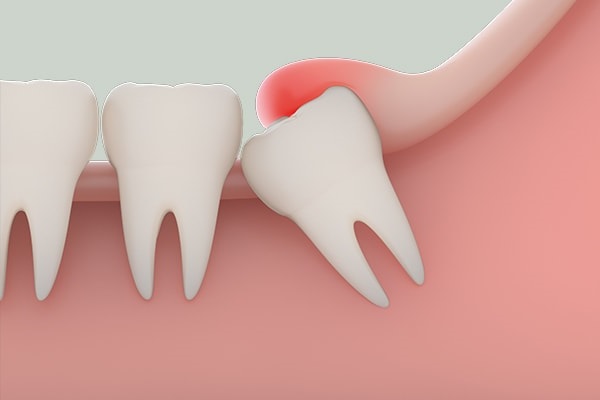 Răng khôn và những điều cần biết khi nhổ răng khôn