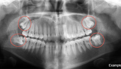 Răng khôn và những điều cần biết khi nhổ răng khôn