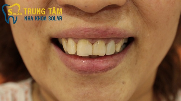 Răng sứ Zirconia thay đổi nụ cười của bạn như thế nào