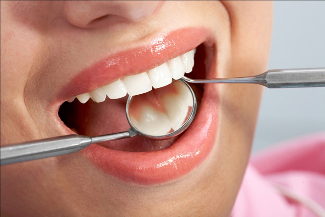 Sau khi trám răng cần lưu ý điều gì Sau khi trám răng cần lưu ý điều gì