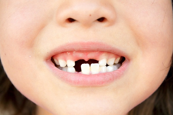Sâu răng ở trẻ và biện pháp ngăn ngừa